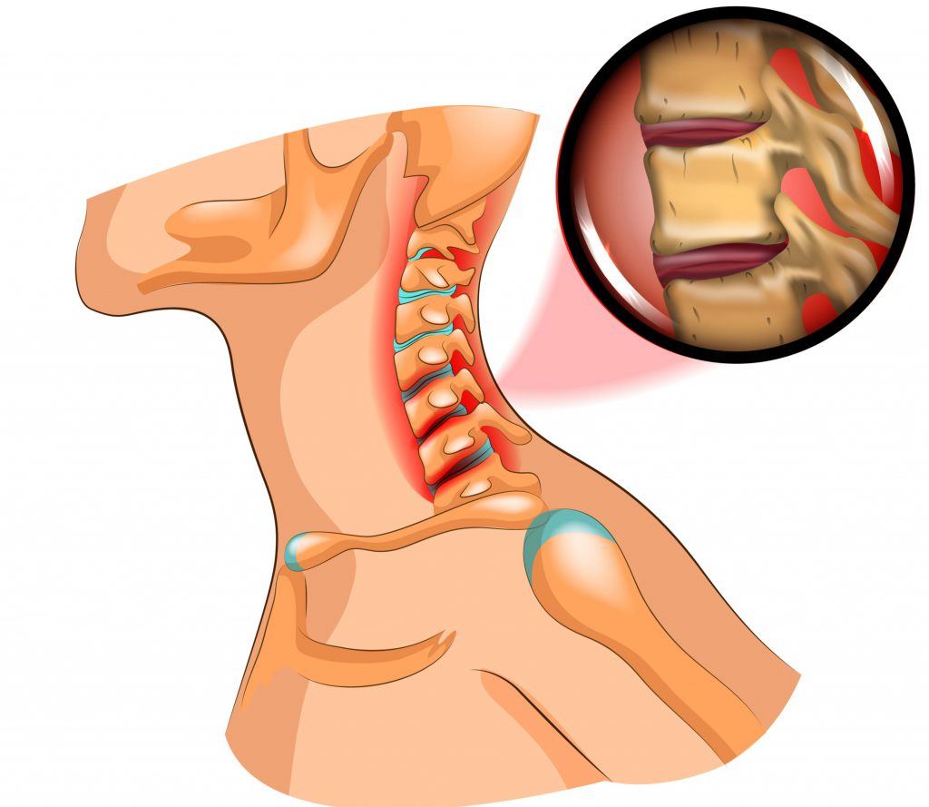 Nekhernia-Symptomen, Oorzaken Behandeling |