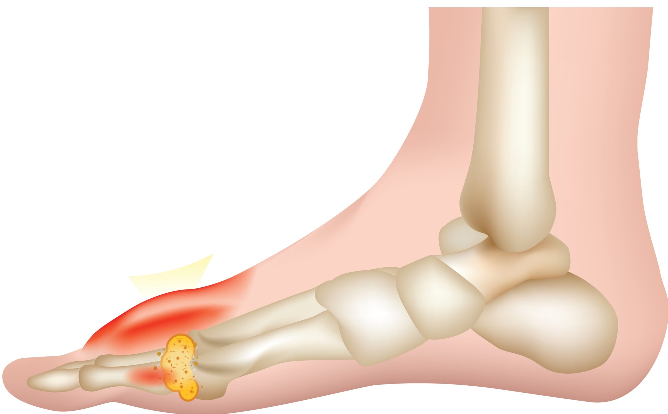 Jicht In De Voet -Symptomen, Oorzaken & Behandeling | Livit Orthopedie